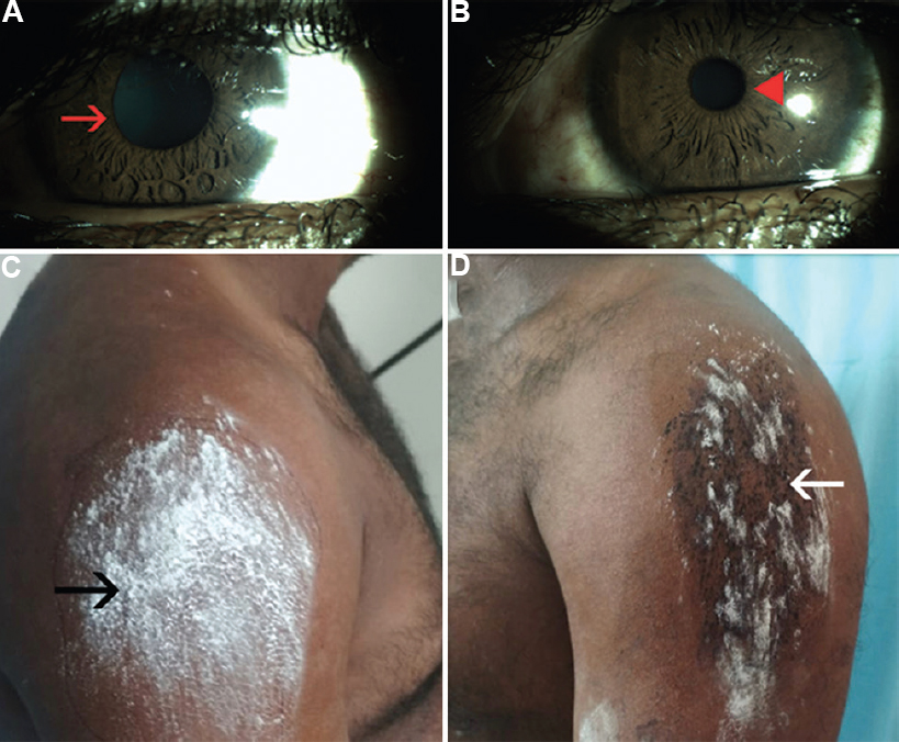 (A) Clinical photograph showing anisocoria in light: right pupillary diameter of 5 mm (red arrow) and (B) left pupillary diameter of 2 mm (red arrowhead); (C) Iodine-starch test of the upper limb showing absence of staining on the right (black arrow indicating area of anhidrosis); and (D) staining on the left (white arrow indicating area of intact sweating).